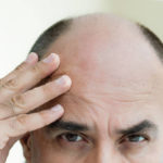 Comment choisir la meilleure clinique de greffe de cheveux à Paris ?